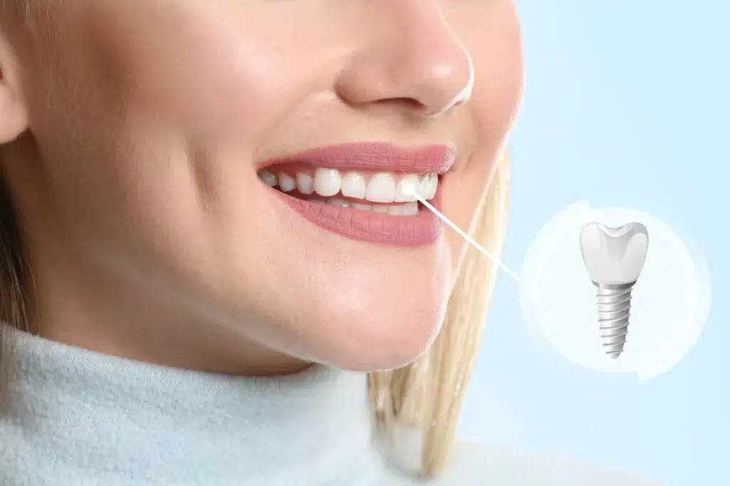Implantes dentales, Khroma Dental, Calahonda, Castell